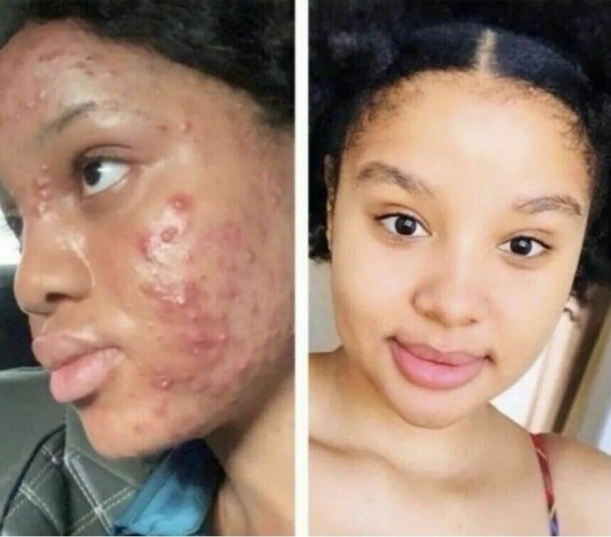 2*Skin Lightening Cream Extra Strength Lighter FAST Result-NO SIDE EFFECTS