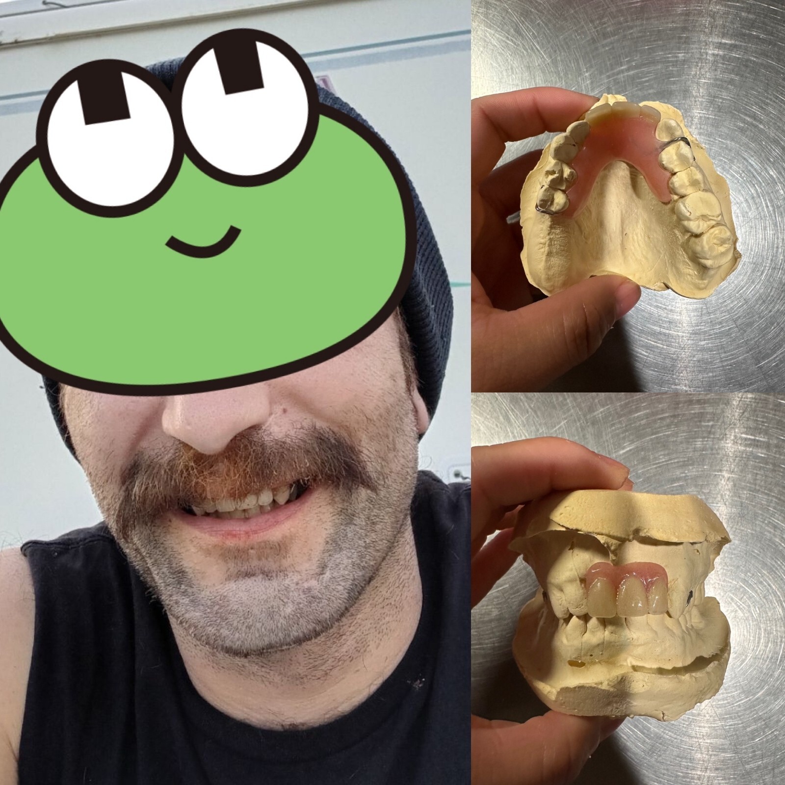 CUSTOM MISSING TEETH FLIPPER/ StayPlate for Upper Lower  (Hard Acrylic MATERIAL)