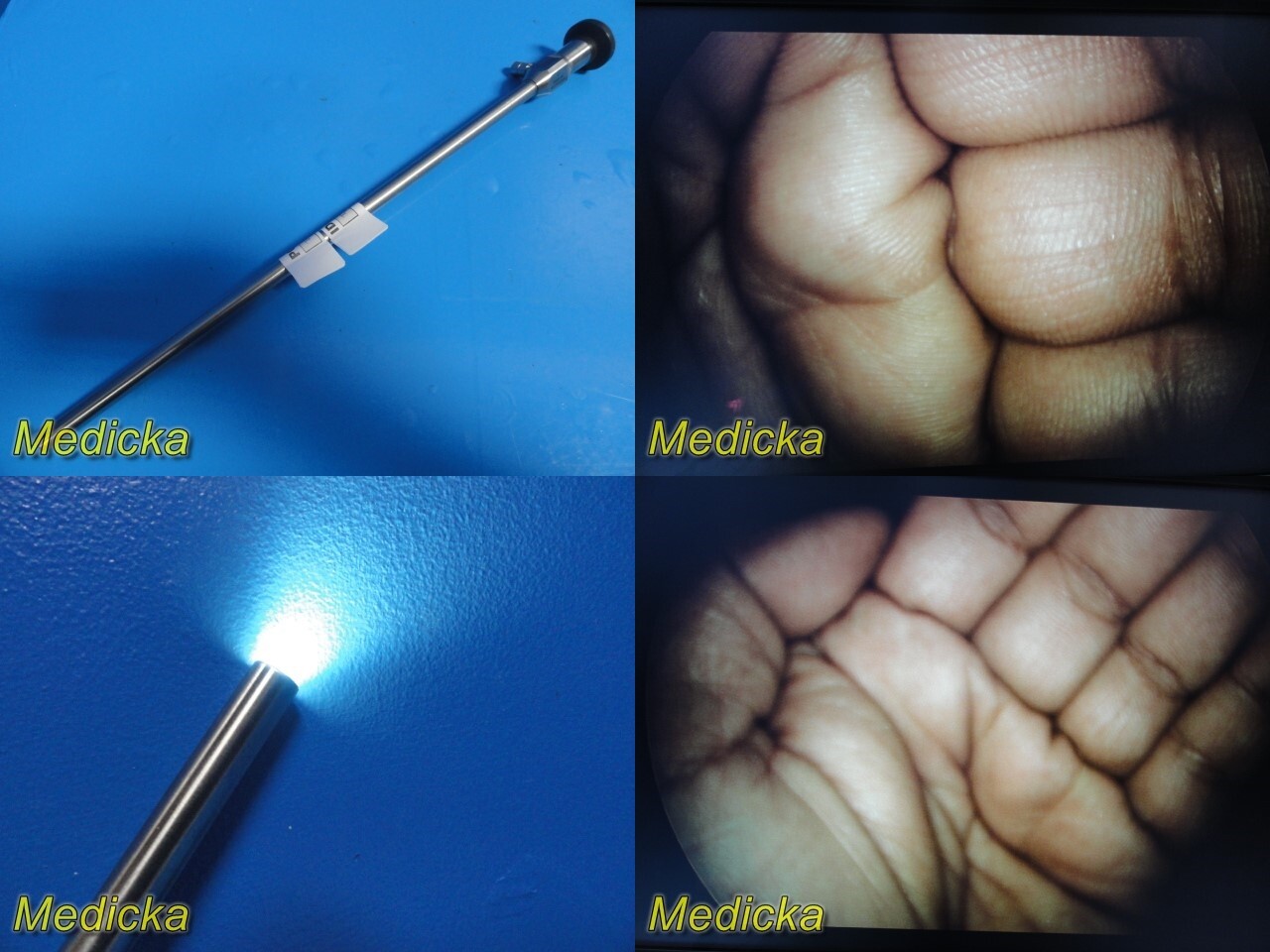 Endolap T2000.00 Millennium 10mmx0° Rigid Telescope, Laparoscope ~ 28338 Endolap T2000.00 Millennium 10mmx0° Rigid Telescope, Laparoscope ~ 28338