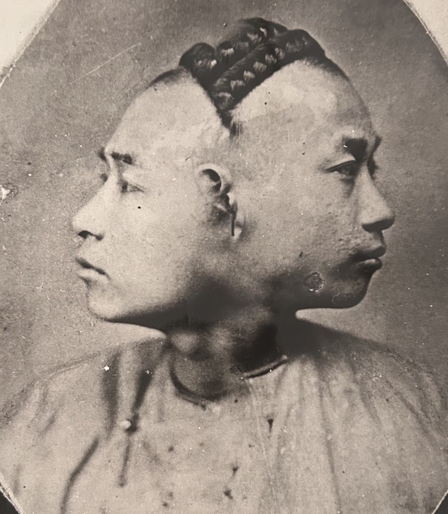 Rare Hong Kong 1883 Two-Headed Anomaly Photo Roger-Viollet Archive RV 66.882