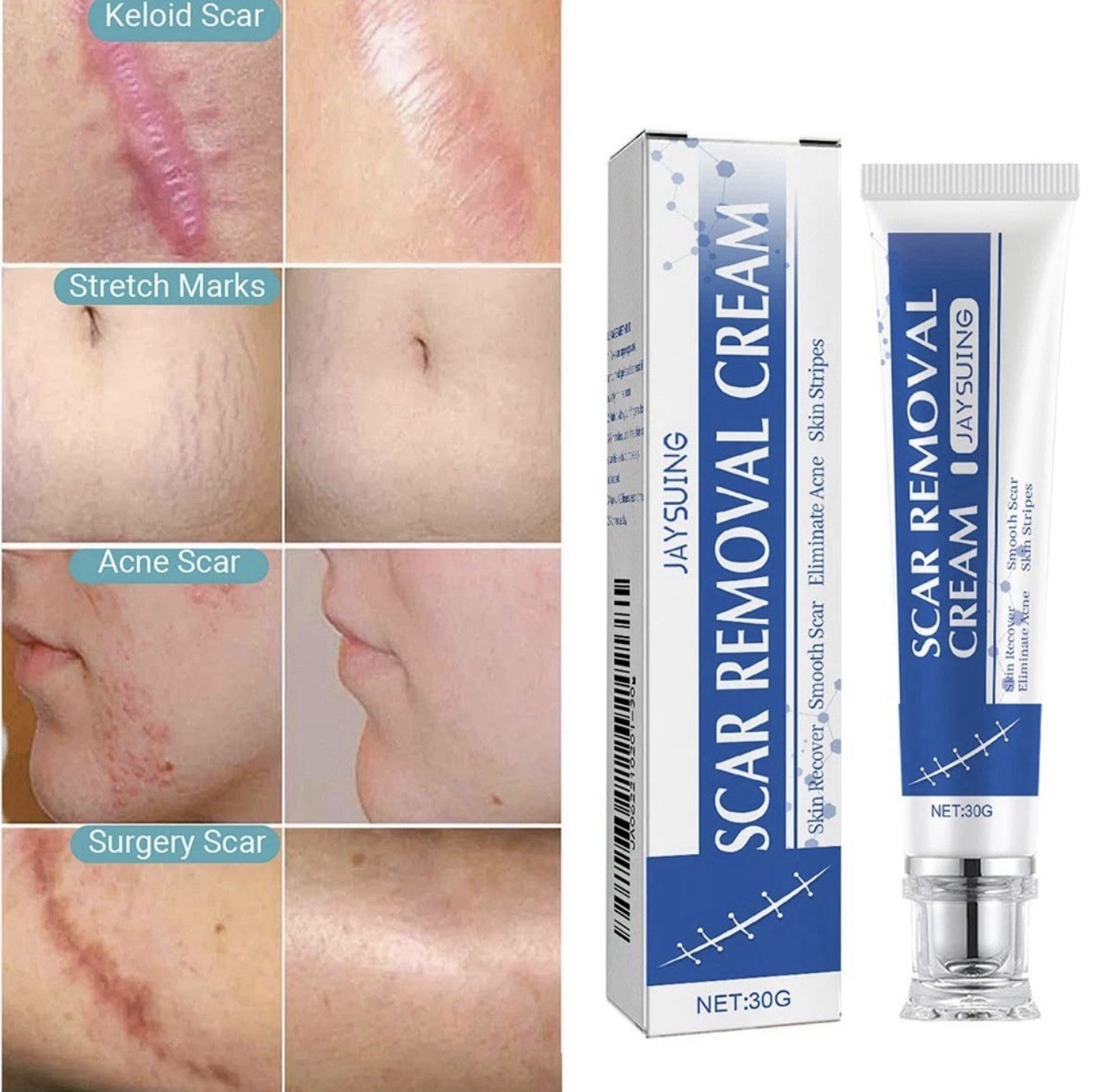 Scar and Acne Mark Removal Gel Ointment Remove Scars Burns Stretch Marks
