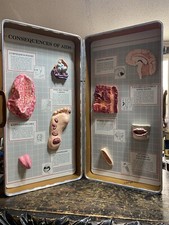 Vintage Health Edco Consequences Of AIDS Display In Case Teaching RARE picture