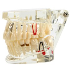 3D Dental Implant Disease Teeth Model Ortho Restoration Bridge Demo Model picture